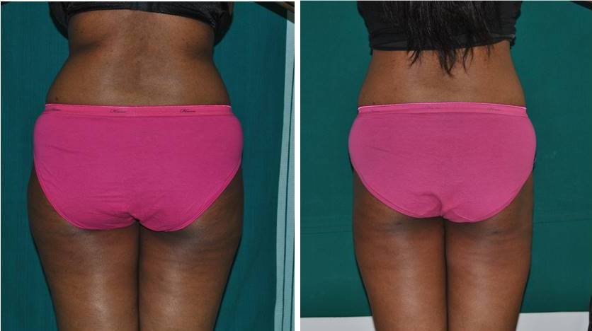 Tumescent liposuction of hips and flanks